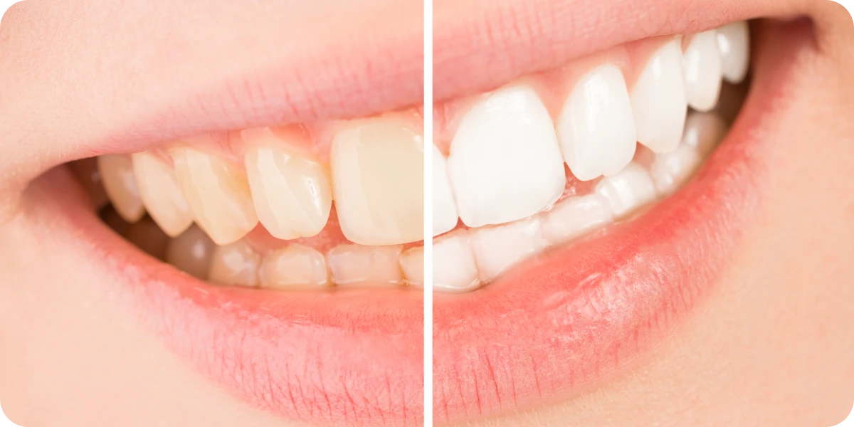 ハイブリッドポリリンホワイトニング