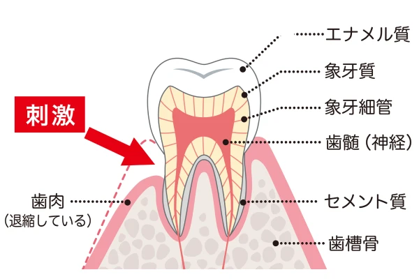 むし歯の治療・予防