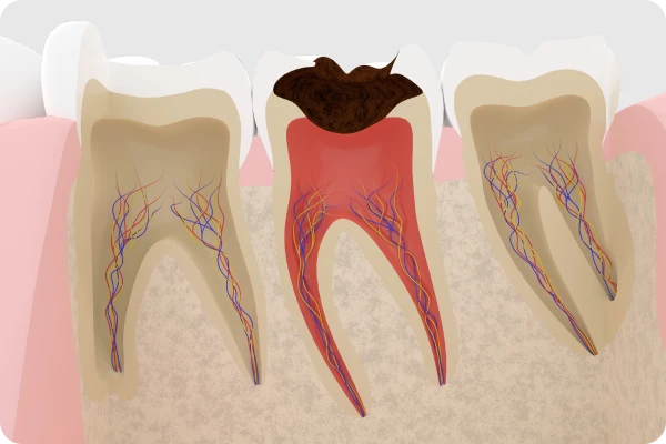 むし歯の治療・予防