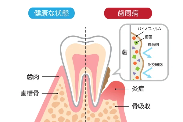むし歯の治療・予防